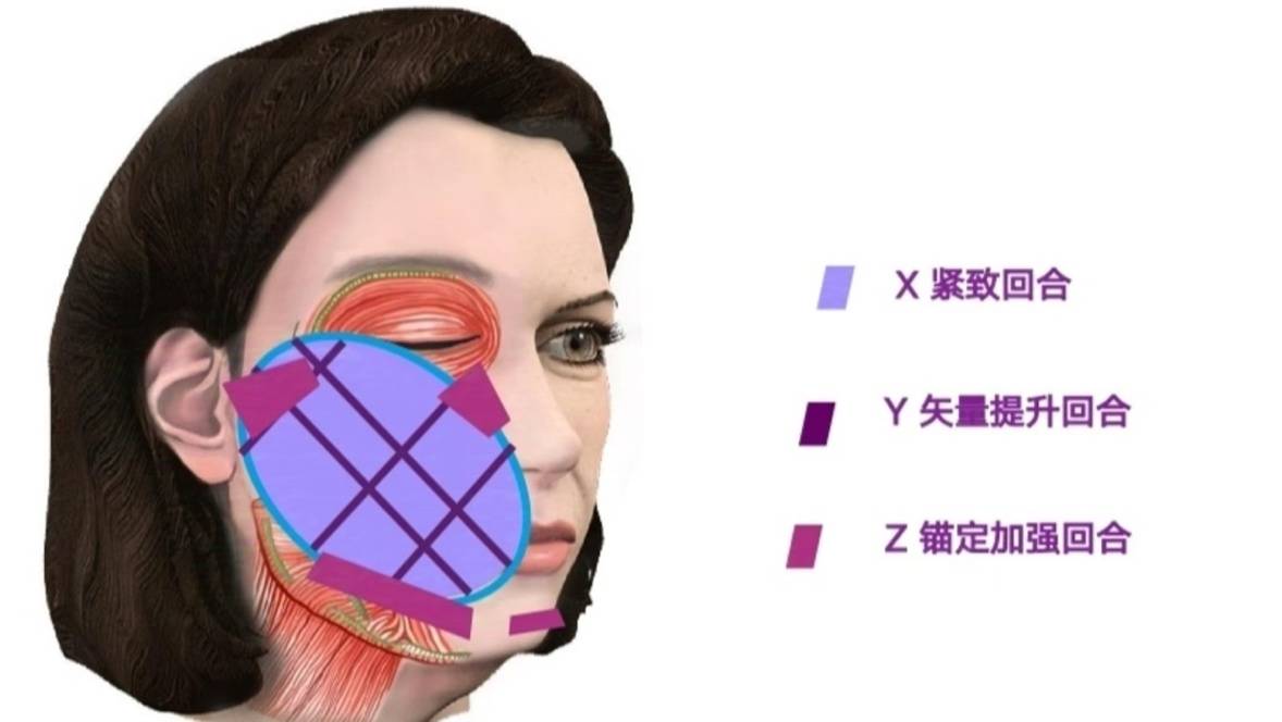 俊泰医疗8.0超玛吉FLX-UP技术：引领行业潮流，极致抗衰体验！
