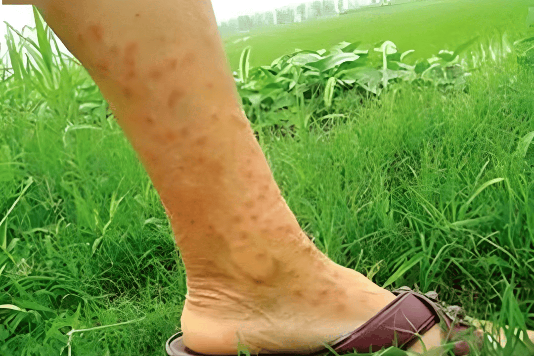 一旦接触，10秒即可感染！汛期谨防这种病→