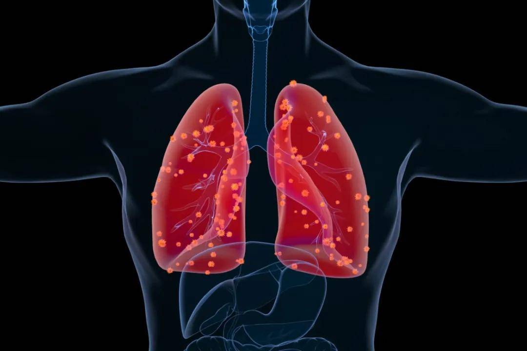 EGFR突变非小细胞肺癌迎来新希望!FDA加速批准Datopotamab Deruxtecan(Dato-DXd)新适应症